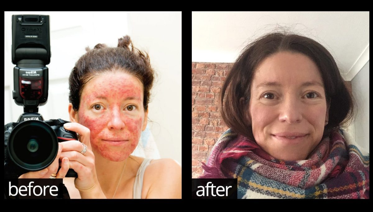 The real reason that nothing has ever worked to resolve your acne, eczema, psoriasis or rosacea - until now! | Chuckling Goat